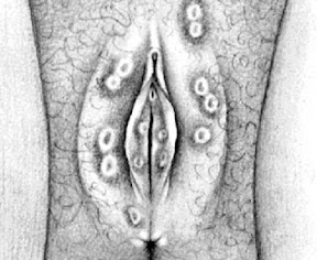 Painful lump on clitorus hood apologise, but Painful lump on clitorus hood sorry, that